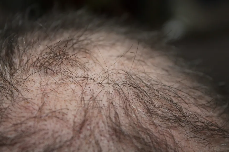 Testosterone And Hair Loss - How Does Testosterone Affect Hair?